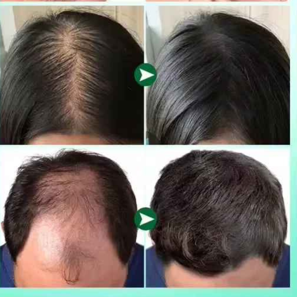 ROSMARY ESSENTIAL GROWTH OIL & DERMAROLLER